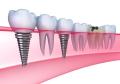 Dental-Implants