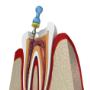 Root Canal Treatment in Mississauga - sketch of close up of a cross-section of a tooth showing root canal therapy with a file in one of the roots Root Canal Treatment in Mississauga - sketch of close up of a cross-section of a tooth showing root canal therapy with a file in one of the roots