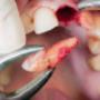 Tooth Extraction in Mississauga - Close up of a person's mouth with an extracted tooth and empty tooth socket Tooth Extraction in Mississauga - Close up of a person's mouth with an extracted tooth and empty tooth socket