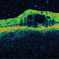 Ocular Coherence Tomography (OCT)