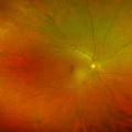 Optomap-Retinal-Scan