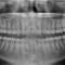 Wisdom-Teeth-Removal