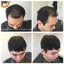 Male hair piece before after Vancouver Male hair piece before after Vancouver