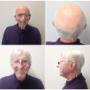 hair piece system with white & grey hair vancouver hair piece system with white & grey hair vancouver