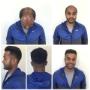 non surgical hair loss young men vancouver non surgical hair loss young men vancouver
