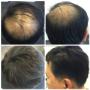 male hair loss hair piece vancouver male hair loss hair piece vancouver