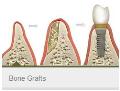 Bone-Grafts