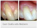 Gum-Grafts-with-AlloDerm