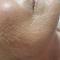Chemical-Peel-after