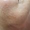 Chemical-Peel