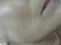 After-the-treatment