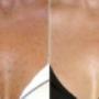 Age Spots on Chest Before & After Age Spots on Chest Before & After
