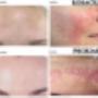 PCA-Before & After Treatments PCA-Before & After Treatments