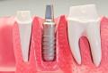 Dental Re-Implants & Re-Alignments