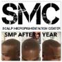 Scalp Tricopigmentation, Scalp Pigmentation Scalp Tricopigmentation, Scalp Pigmentation