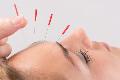 Acupuncture Treatment Barrie