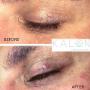 Eye Treatment - Kalon Medical Aesthetics Eye Treatment - Kalon Medical Aesthetics