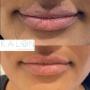 Lip Treatment - Kalon Medical Aesthetics Lip Treatment - Kalon Medical Aesthetics