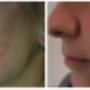 Ance scaring results Ance scaring results