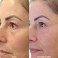 Eye-thread-lift