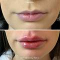 Lip-Injectables