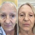 Nonsurgical-Facelift
