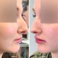 Nose-thread-lift